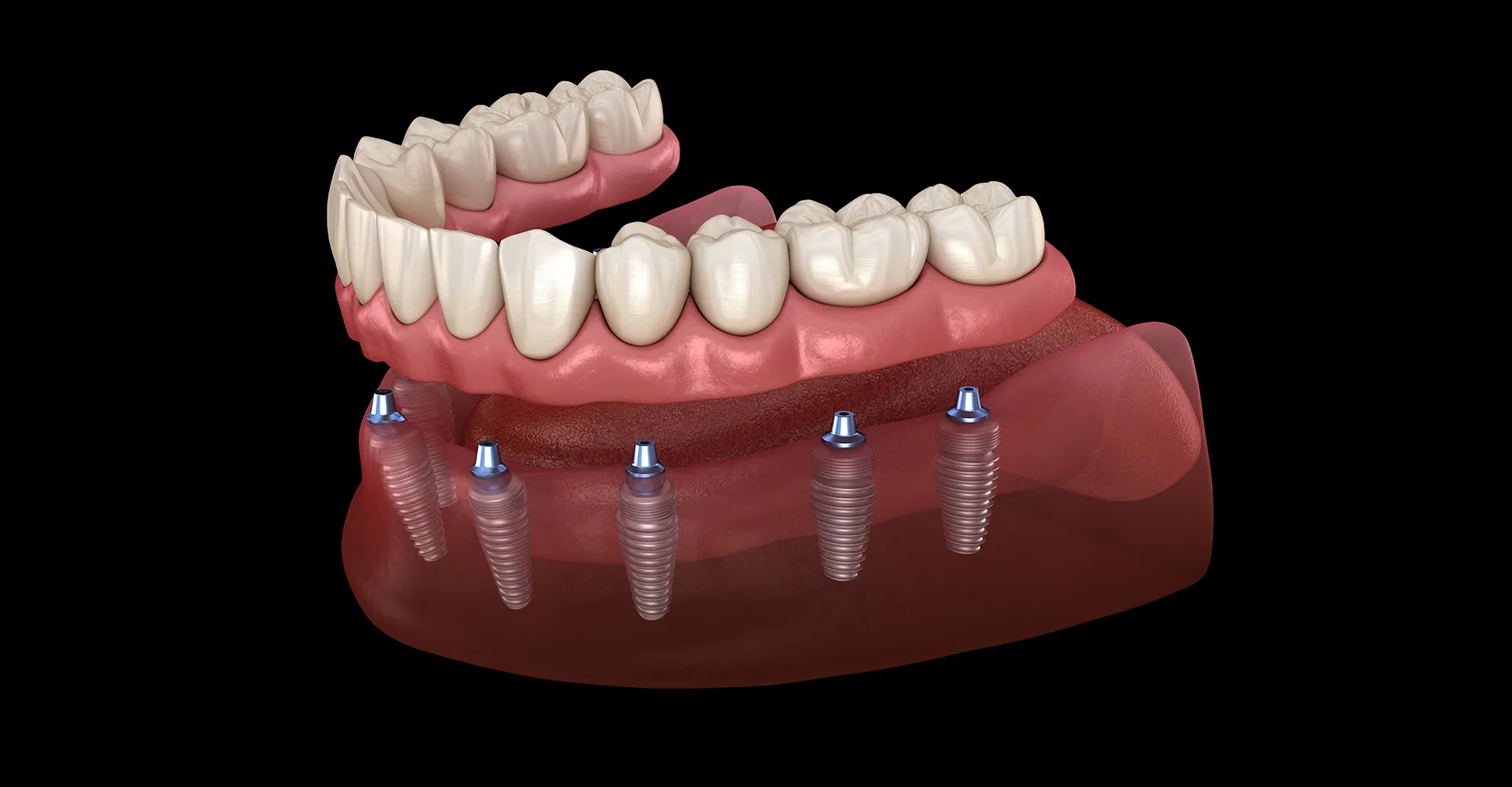 Computer guided dental implant placement procedure