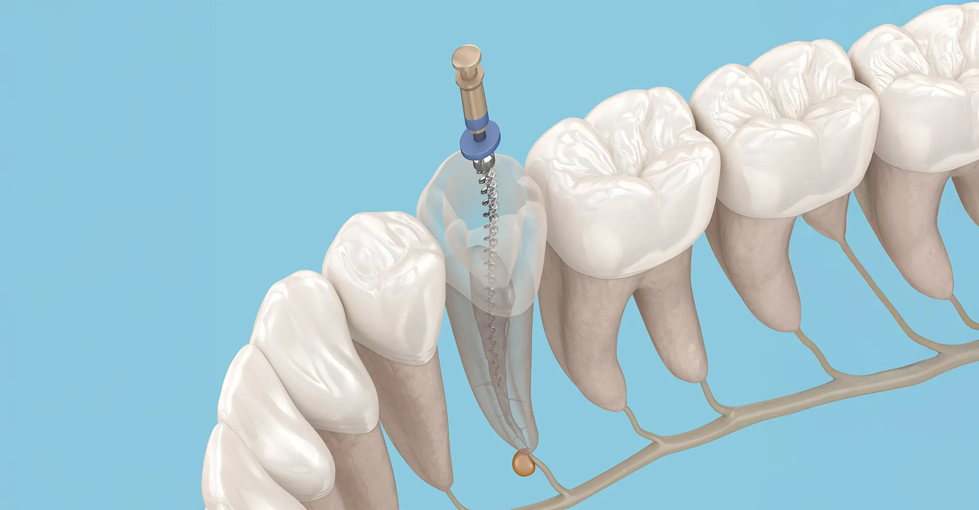Microscope-assisted root canal therapy in Dubai