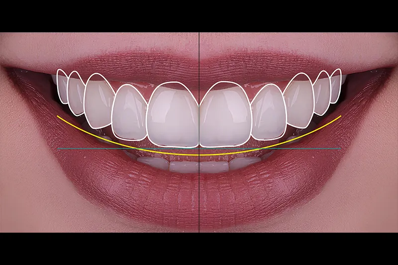 Digital Smile Design simulation for Hollywood smile makeovers