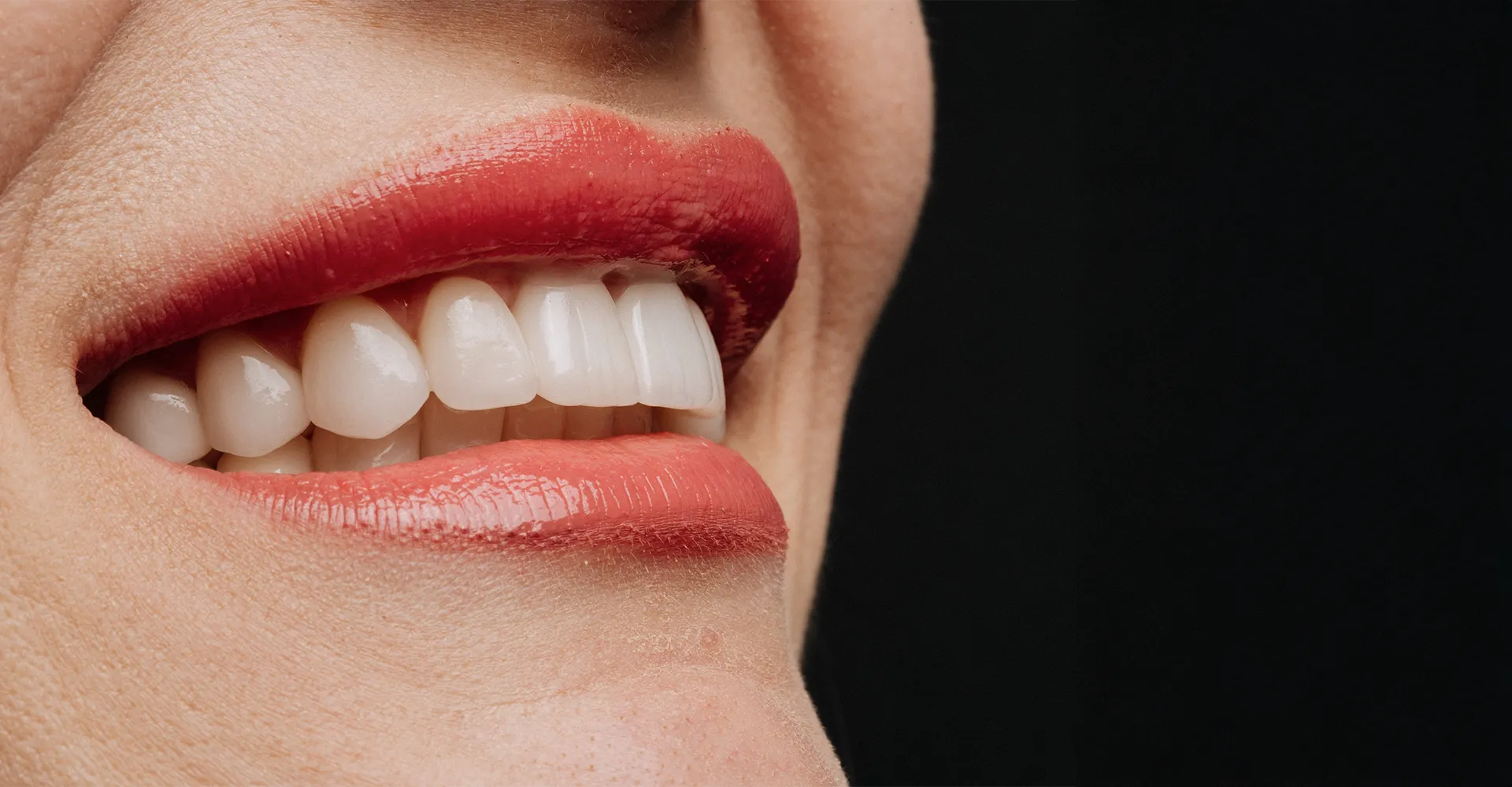 Custom porcelain veneers placed at Revive Dental Clinic Dubai