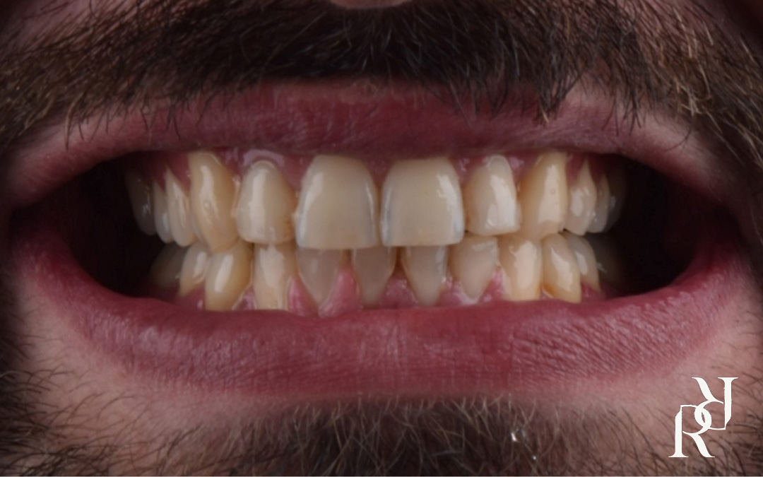 Orthodontic braces teeth alignment before and after