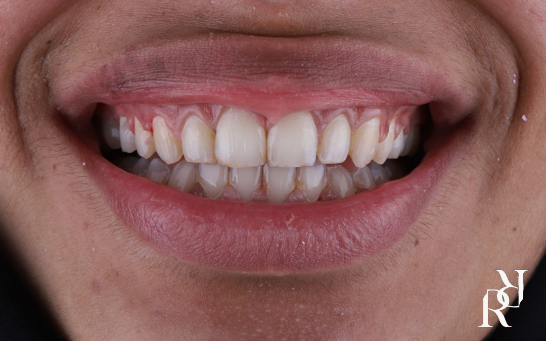 Metal braces alignment case study Revive Dental Clinic