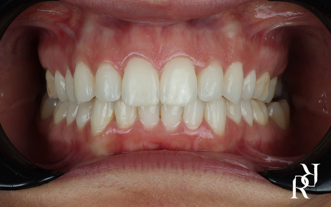 Invisalign clear aligner teeth straightening result