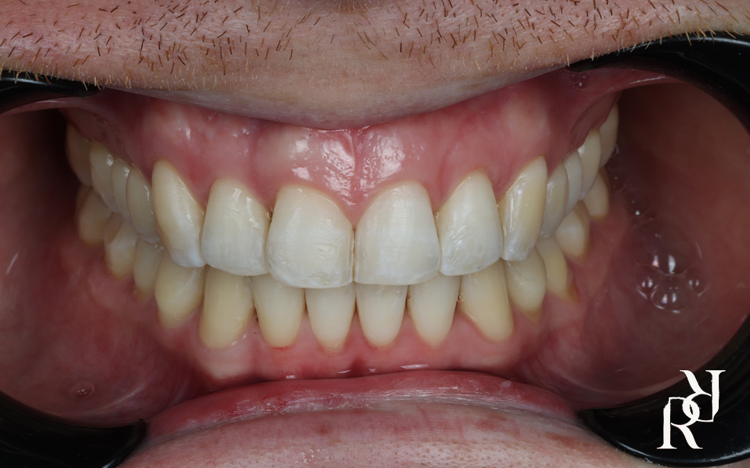 Clear aligner treatment for open bite and spacing