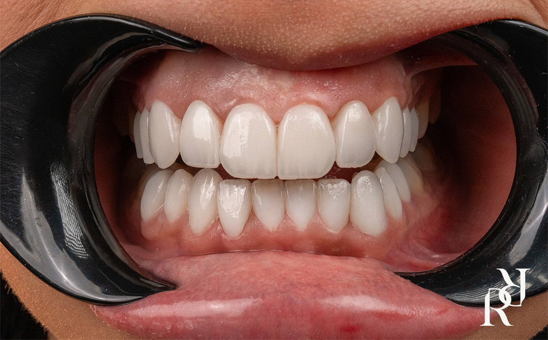 Porcelain Veneers Before and After smile makeover in Dubai