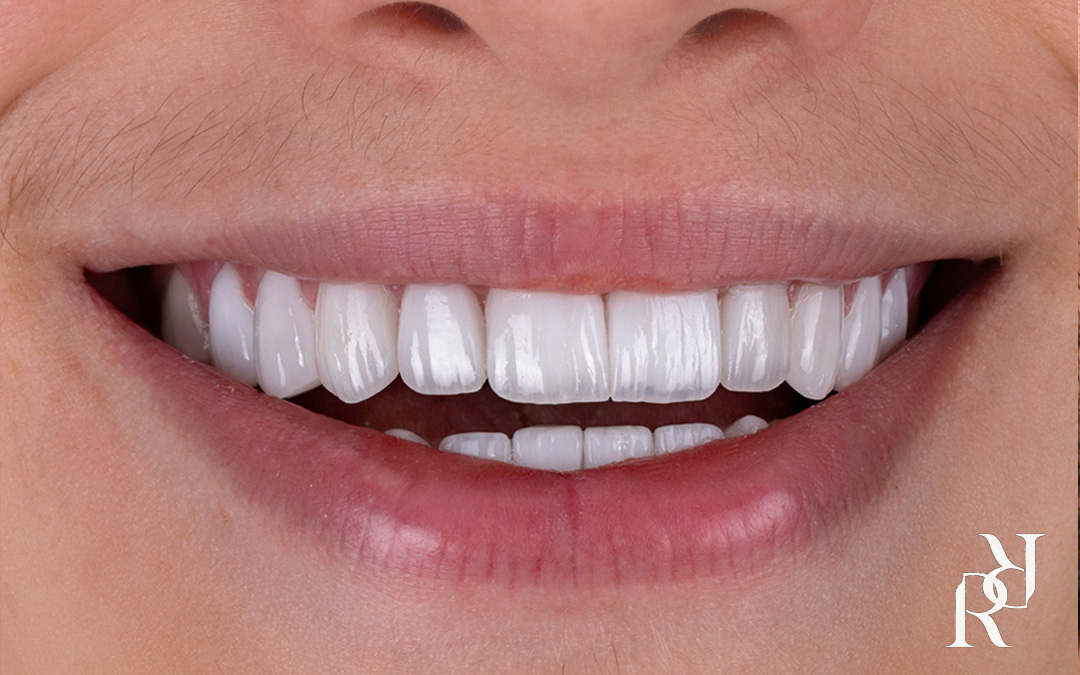 Ultra thin aesthetic dental veneers transformation