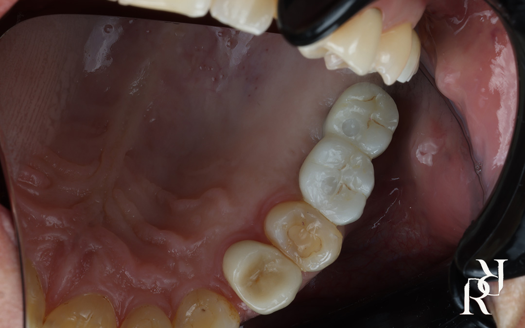 Dental implant tooth replacement before and after