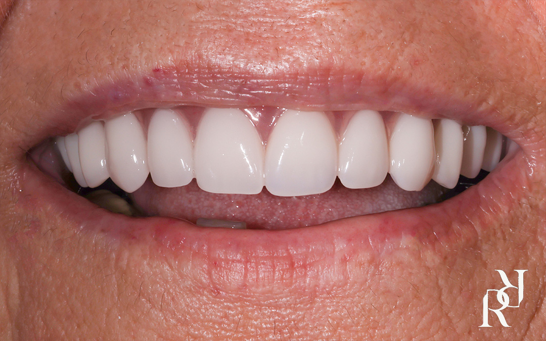 All on 4 full arch implant restoration transformation