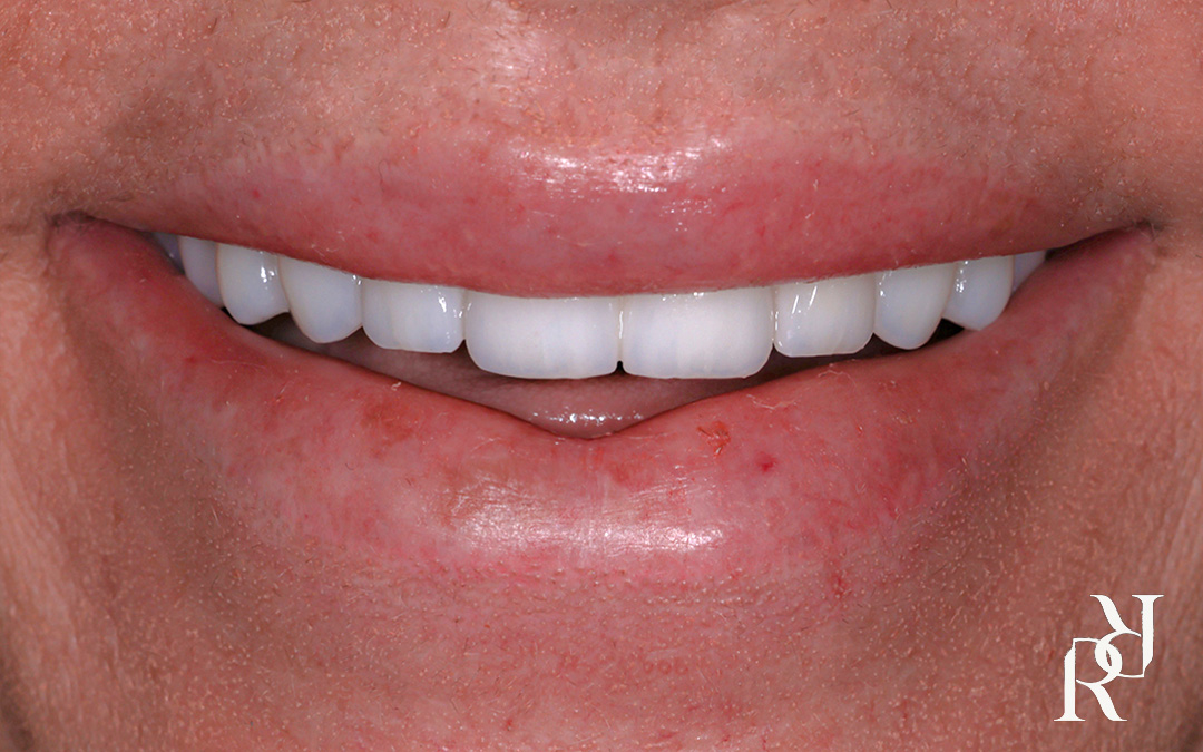 Multiple missing teeth restored with dental implants